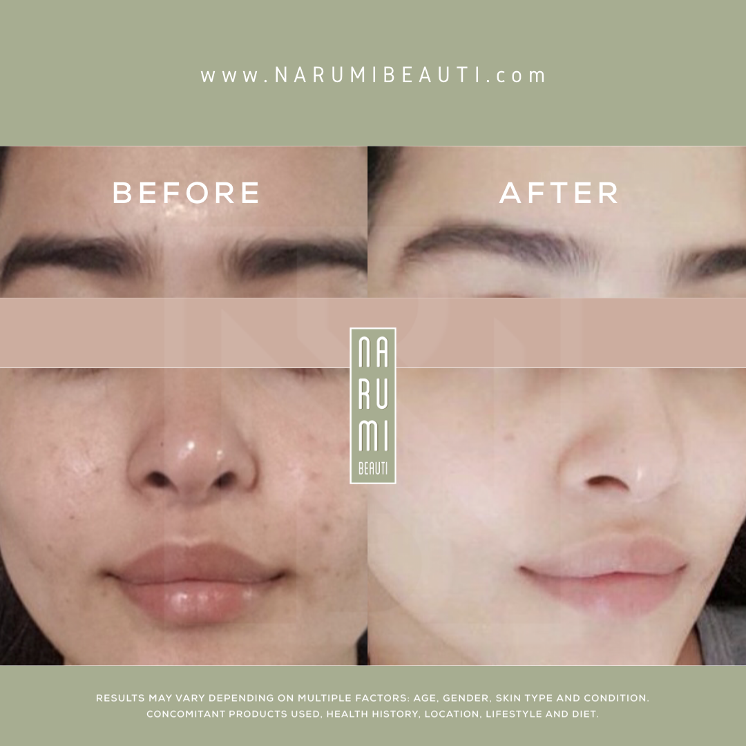 Clarifying Acne Pads