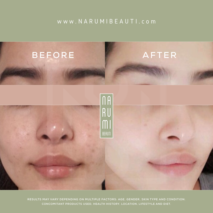 Clarifying Acne Pads