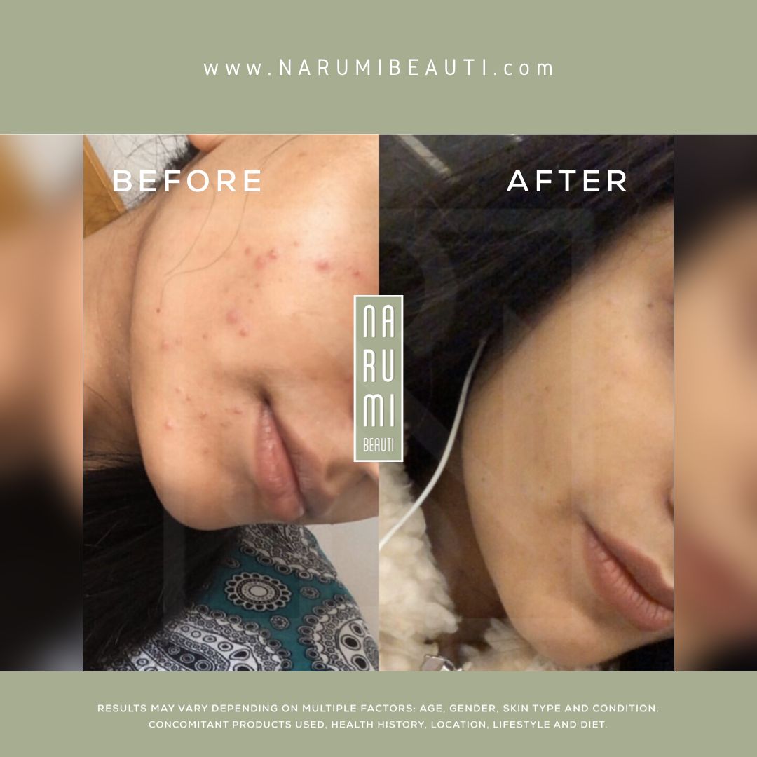 Clarifying Acne Pads