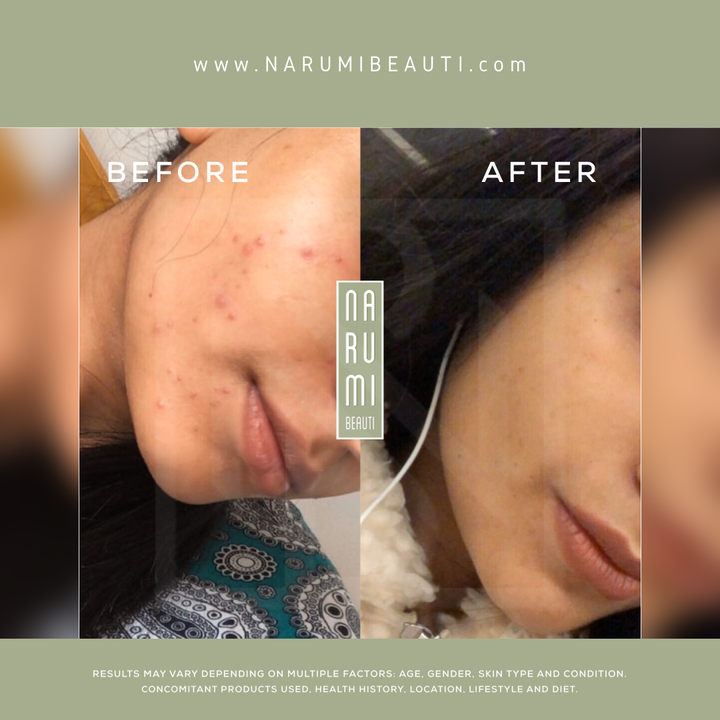 Clarifying Acne Pads