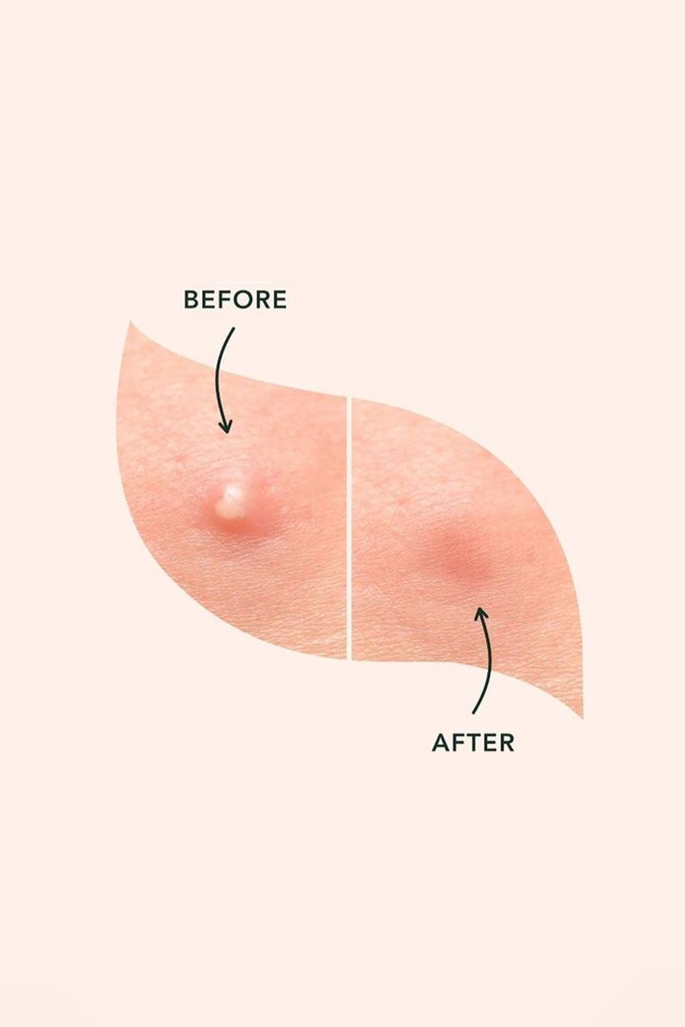 Pro-Radiance Acne Cleanser