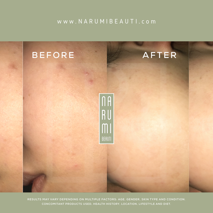 Before and after clear glowing skin hydrated skin 