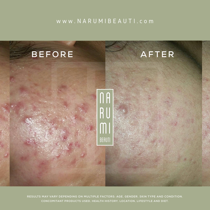 Clarifying Acne Pads