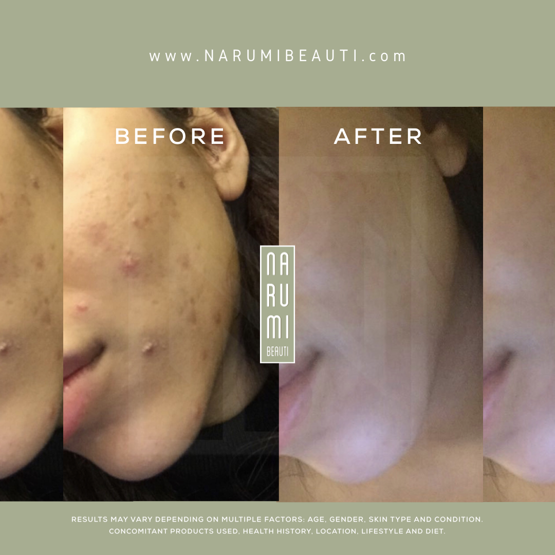Customer skin before and after using Narumi